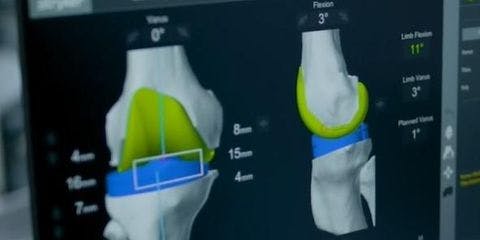 Andrew's story - Knee replacement using the Mako robot